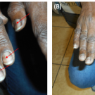 Essential Thrombocytosis