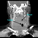 Diffuse Large B-Cell Lymphoma of the Thyroid