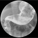 Rapunzel Syndrome Mimicking Crohn Disease