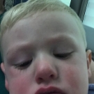 Campylobacter Enteritis