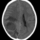 Oral Albuterol Overdose