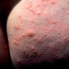 Cold-Induced Urticaria