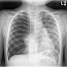 Langerhans Cell Histiocytosis Presenting as Pneumothorax