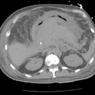 Diffuse Large B-Cell Non-Hodgkin Lymphoma