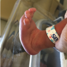 Congenital Vertical Talus