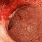 Ulcerative Colitis
