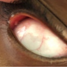 Conjunctival Pyogenic Granuloma