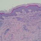 Palisaded Neutrophilic Granulomatous Dermatitis