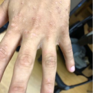 Scabies