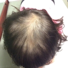 Alopecia Areata and Hypothyroidism