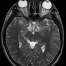 Isolated Idiopathic Intracranial Hypertension
