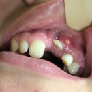 dental abscess