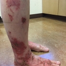 Necrolytic Migratory Erythema