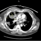 Pulmonary Actinomycosis