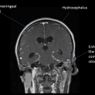 Streptococcal Meningitis