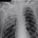 Tracheal Perforation