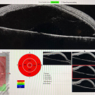 Vogt-Koyanagi-Harada Disease