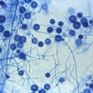 Histoplasmosis