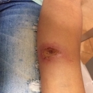 Cutaneous Leishmaniasis