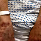 Erythema Multiforme Minor