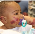 An Infant’s Sudden-Onset Rash and Swelling