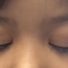 Epstein-Barr Virus Infection