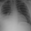 Invasive Streptococcus pneumoniae Infection in an Afebrile Adolescent with HIV