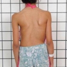Adolescent Idiopathic Scoliosis