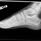 What is Causing a 5-Year-Old Boy’s Limp?