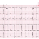 Gitelman Syndrome With a Normal Magnesium Level
