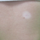 A Teenager With a Changing Mole on Her Back