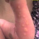 Incontinentia Pigmenti In a Neonate