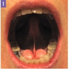 Torus Mandibularis and Buccal Exostoses