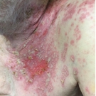 Atypical Painless Presentation of Herpes Zoster