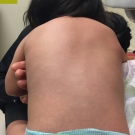 An Infant With Scoliosis: Is It Idiopathic?