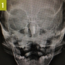 Nasal Foreign Body in an Infant