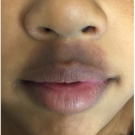 Facial bruise