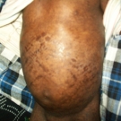 Hutchinson-Gilford Progeria Syndrome