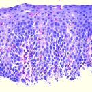 Eosinophilic Esophagitis as a Complication of Sublingual Immunotherapy