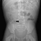 Cerebrospinal Fluid Pseudocyst in a Toddler