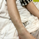 Inflammatory Bowel Disease Presenting as a Rash