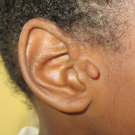 Accessory Tragus