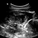 Hemorrhagic Follicular Cyst in a Teenager