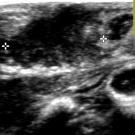 Mastitis in a Neonate
