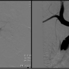Takayasu Arteritis in a Child