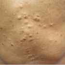 steatocystoma multiplex located in the presternal area