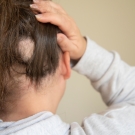 Person with patch of hair missing from alopecia