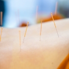 acupuncture