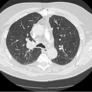 Chest CT at the diagnosis showed a right suprahilar mass