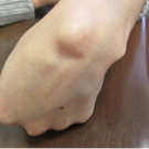 The most common sites of ganglion cysts include the dorsum of the wrist 